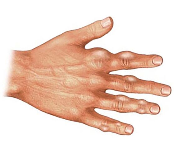 Deposition of uric acid crystals in the soft tissue of the fingers with gouty arthritis