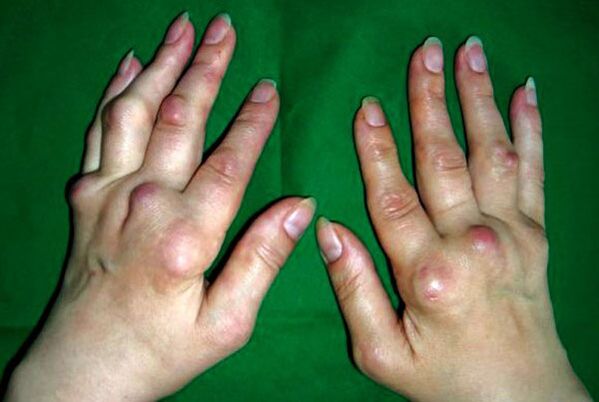 Hands affected by polyosteoarthritis deformers