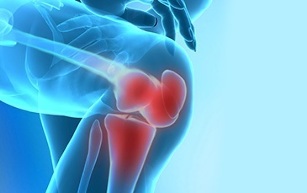how knee osteoarthritis manifests itself
