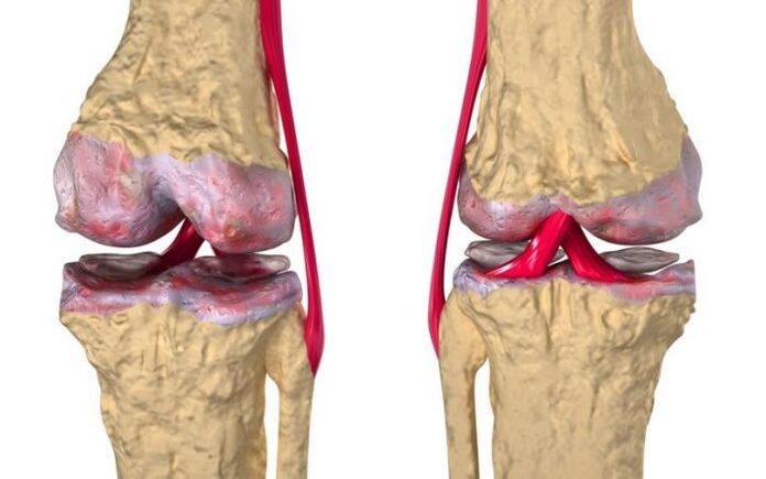 Knee joint arthrosis